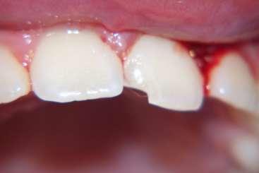 Uncomplicated Fracture of Enamel This type of fracture is a crack of the enamel that does not involve the dentin or the pulp. It may have a sharp edge.