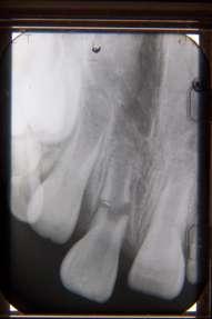 Root Fracture Excessive mobility of the tooth may indicate a root fracture. This type of fracture includes pulp exposure.