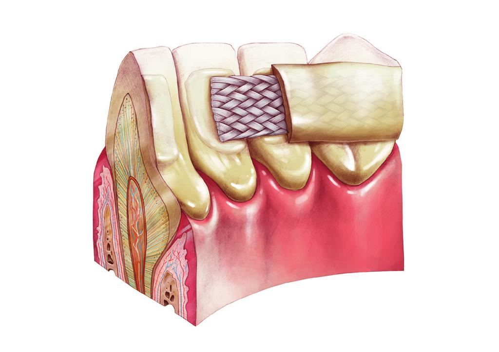 PROTECTING ENAMEL DURING REMOVAL OF TEMPORARY SPLINTS AND RETAINERS PROBLEM Cross section of a tooth with a