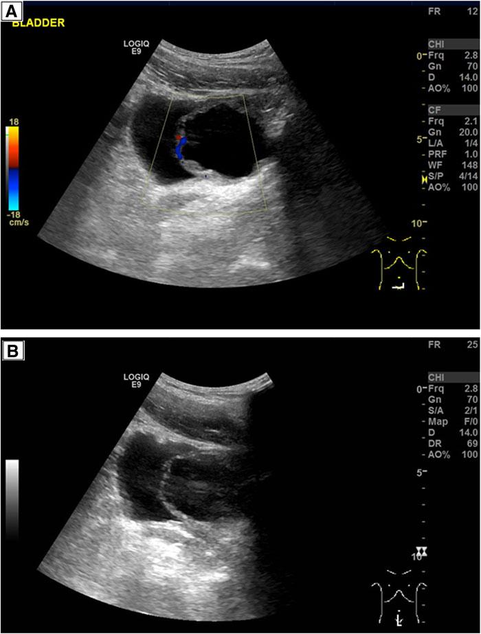 35 FIG. 1. (A, B) Abdominal ultrasound scan showing the cystic lesion and thickened bladder wall.