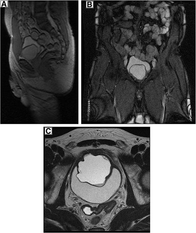36 FIG. 2. CT urogram showing the cystic bladder lesion. (A) Sagittal CT scan; (B) coronal cross-section showing the contrast-enhancing cystic bladder lesion.