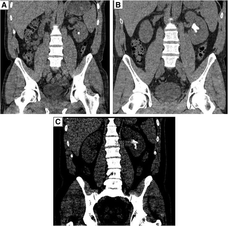 37 FIG. 4. CT scan showing the progression of the left renal calculus from two 5 mm stones to a large staghorn calculus. (A) Noncontrast CT scan showing the small left lower pole renal calculus.