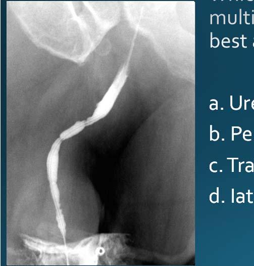 Multifocal urethral strictures a.