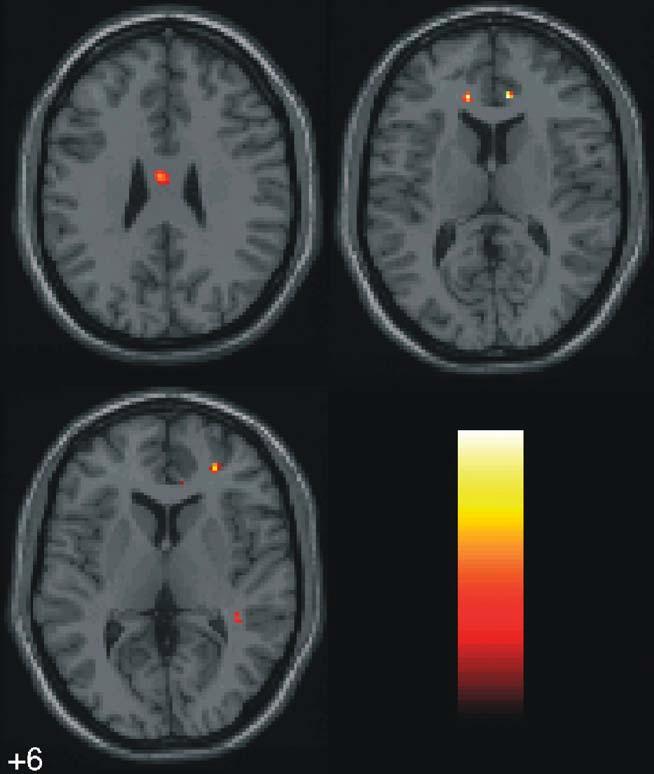 DEVELOPMENT OF WHITE MATTER IN AUTISM +28 +6 a d e +12 Fig.