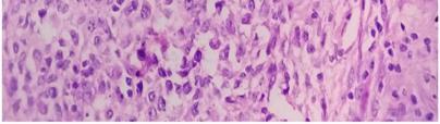 Among tumors of fibrohistocytic differentiation (14 cases), 11 cases were diagnosed as benign and 3 belonged to intermediate category.