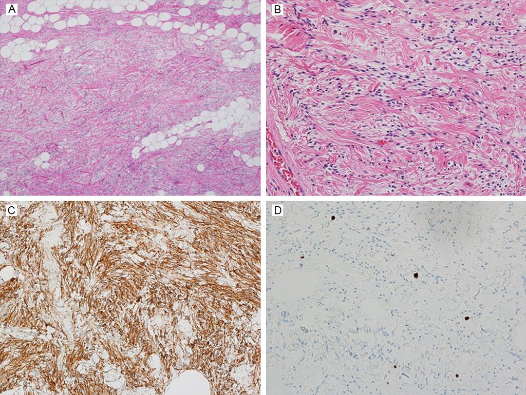 Figure 3. (A, B) Histologically, the tumor was composed of mature adipocytes and proliferation of the less atypical spindle cells in a ropey-like collagen background.