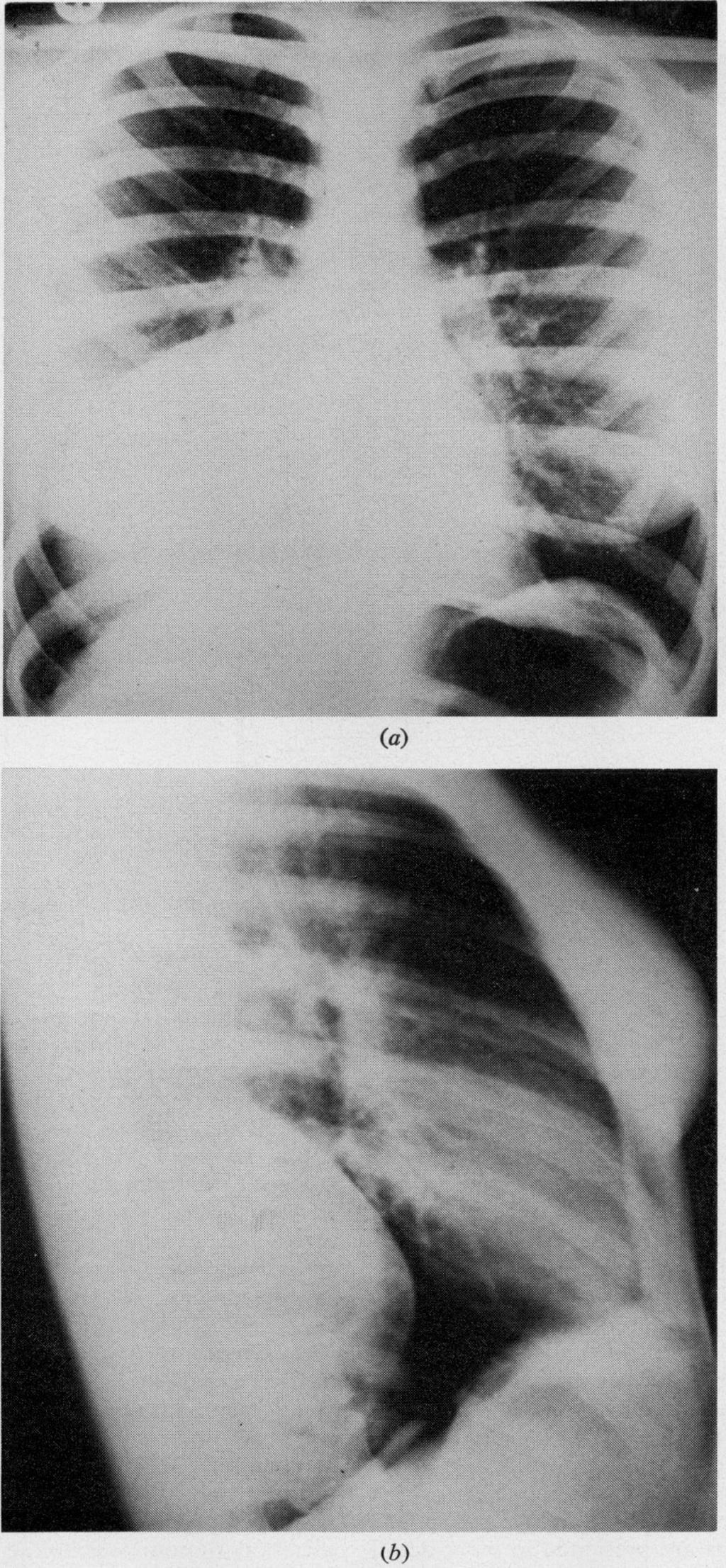0.7-.4..!:... 114, (a) Thorax: first published as 10.1136/thx.33.3.359 on 1 June 1978. Downloaded from http://thorax.bmj.com/ (b) Fig.