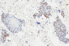 TTF1 immunohistochemical stain FNA diagnosis Epithelial neoplasm with squamous features + (descriptive comment) The presence of bland squamous nests raise the differential of squamous metaplasia