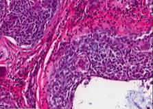 DX: SCLEROSING MUCOEPIDERMOID CARCINOMA WITH EOSINOPHILIA with prominent squamous