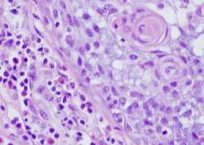 prominent association of eosinophils and lymphocytes Other DDX: Metaplasia in
