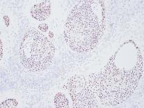 5% thyroid cancers F:M (2:1) Lymph nodes metastasis common Immunophenotype