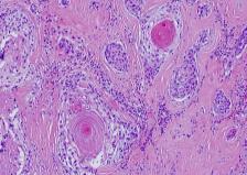 Mucoepidermoid carcinoma May be associated with papillary thyroid carcinoma &