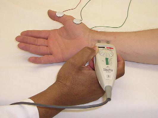 THE ELECTRODIAGNOSIS OF NEUROPATHY 3 be used to calculate a nerve conduction velocity, another measure of conduction speed.