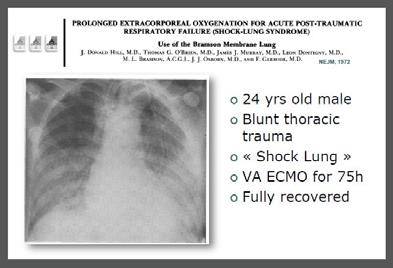 HISTORY OF ECMO 1960 - EXPERIMENTS INTO PROLONGED CPB 1972 - HILL -