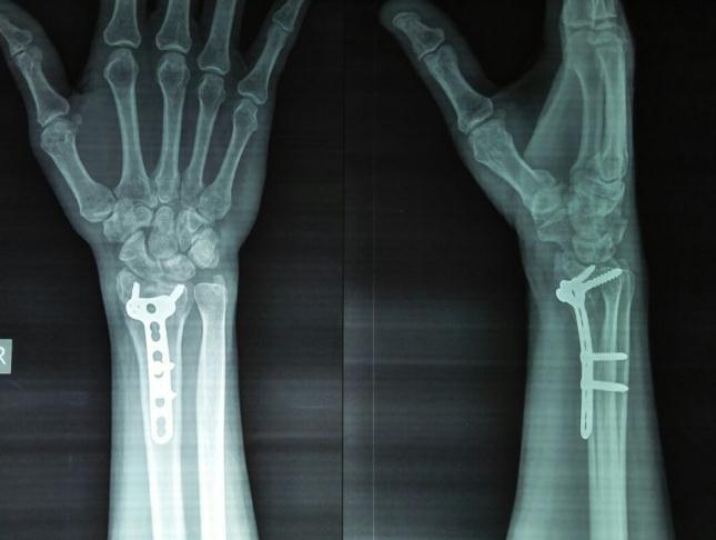 The series of Vargaonkar evaluated the results of various treatment modalities of distal end radius fracture.