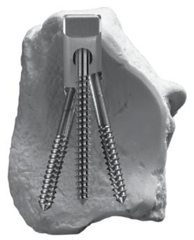 The Tissue Protector must be seated directly on the bone in order to obtain accurate screw length. The next two Buttress Screws are typically 2mm less than the first.
