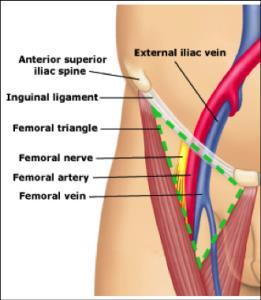 Femoral Vein Useful for code/crash situation where neck is inaccessible due to active airway management or chest is occupied with ongoing CPR Used if patient