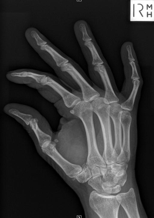 rd metacarpal-phalangeal joint 1. Place hand with palm down against cassette 2.