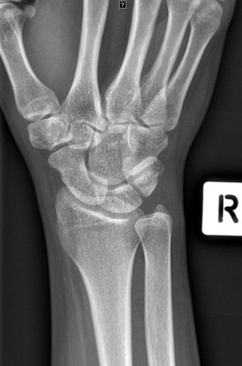 between styloid process of radius and ulna 1. Place anterior surface of wrist flat on cassette 2. Raise thumb approx.