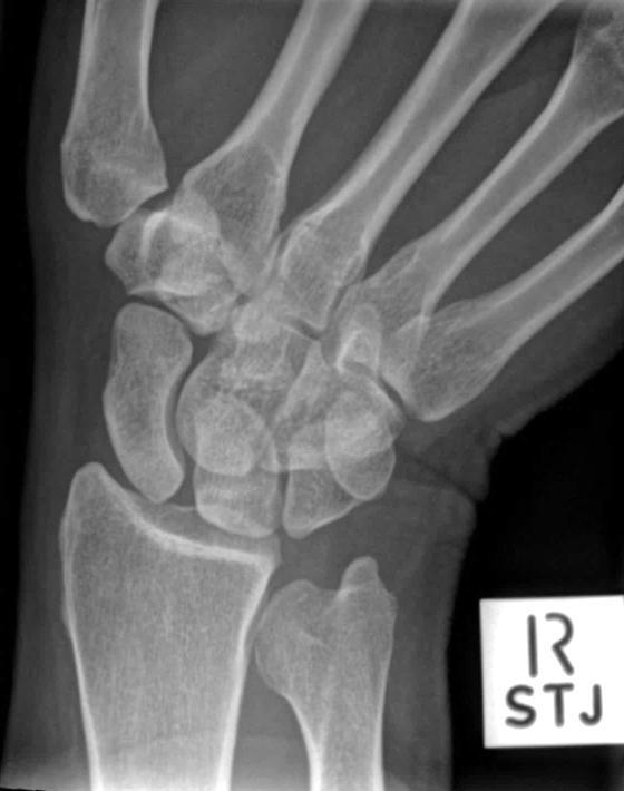 end of radius/ulna Centre Point: Carpal bones 1. Place anterior surface of wrist flat against cassette 2.