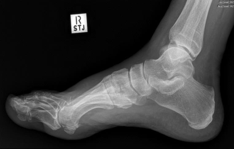 Centre Point: Base of metatarsals 1. Patient supine and rolled slightly onto affected side 2.