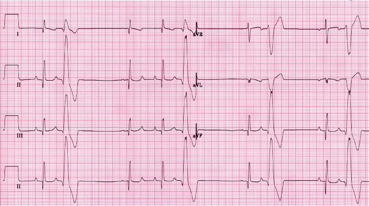 ARVC IN BOXER: ECG Typical