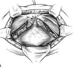 fascia or around urethra Colleselli J Urol 1998; 160:49 Technique for preserving continence Females Routinely perform sacroculpopexy with mesh Interpose