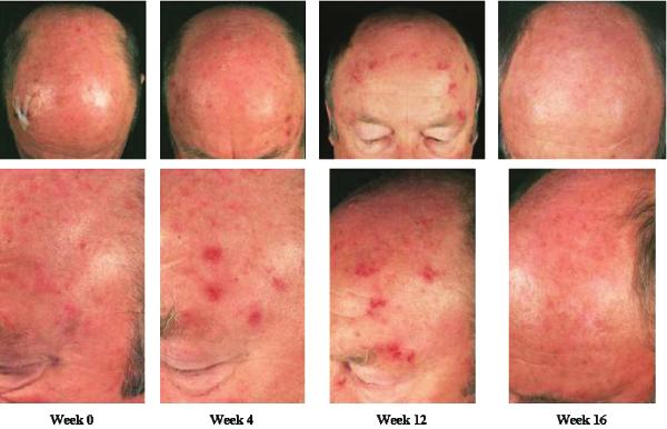 894 EKLIND ET AL.: IMIQUIMOD AND EPIDERMAL CANCERS Dermatol Surg 29:8:August 2003 Figure 4. Several confluent actinic keratoses can be appreciated on the forehead.