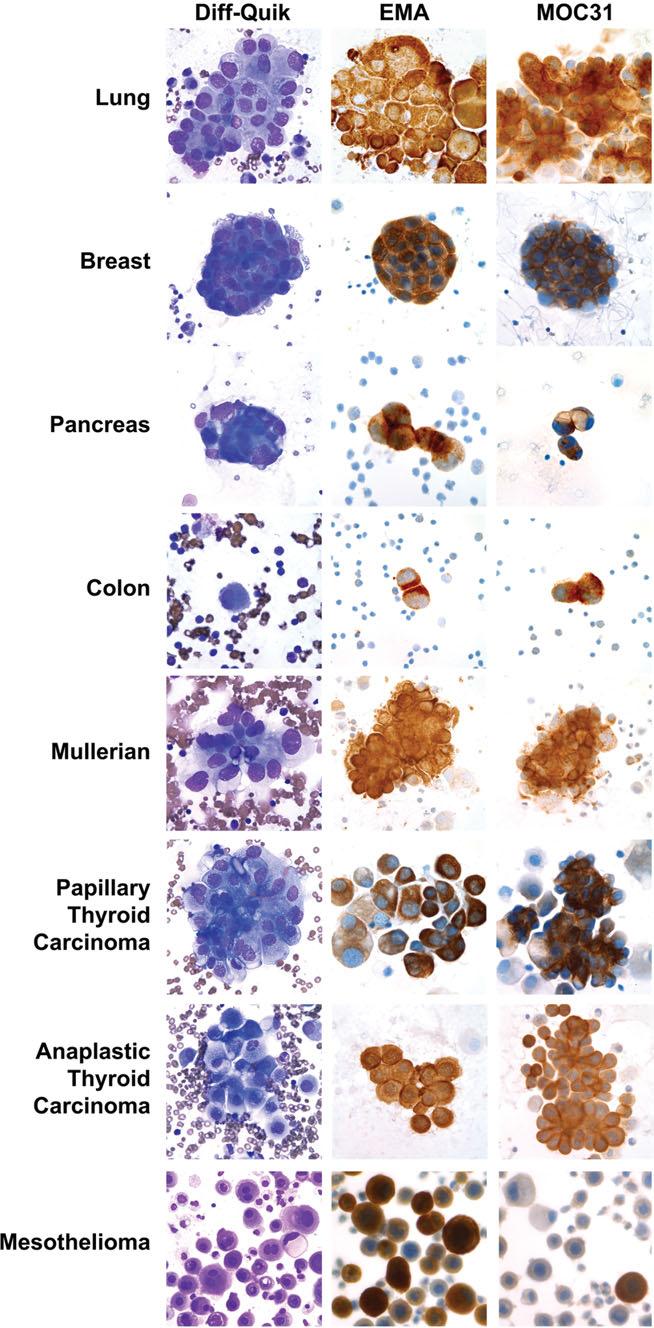 IMMUNOCYTOCHEMISTRY ON DIRECT SMEARS OF EFFUSIONS results were obtained, represented positive controls.