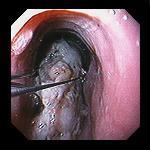 Foreign Body Ingestion Endoscopic Management Emergencies: Complete obstruction of esophagus Respiratory distress Disk