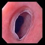 Foreign body / Esophageal impaction Inability to swallow