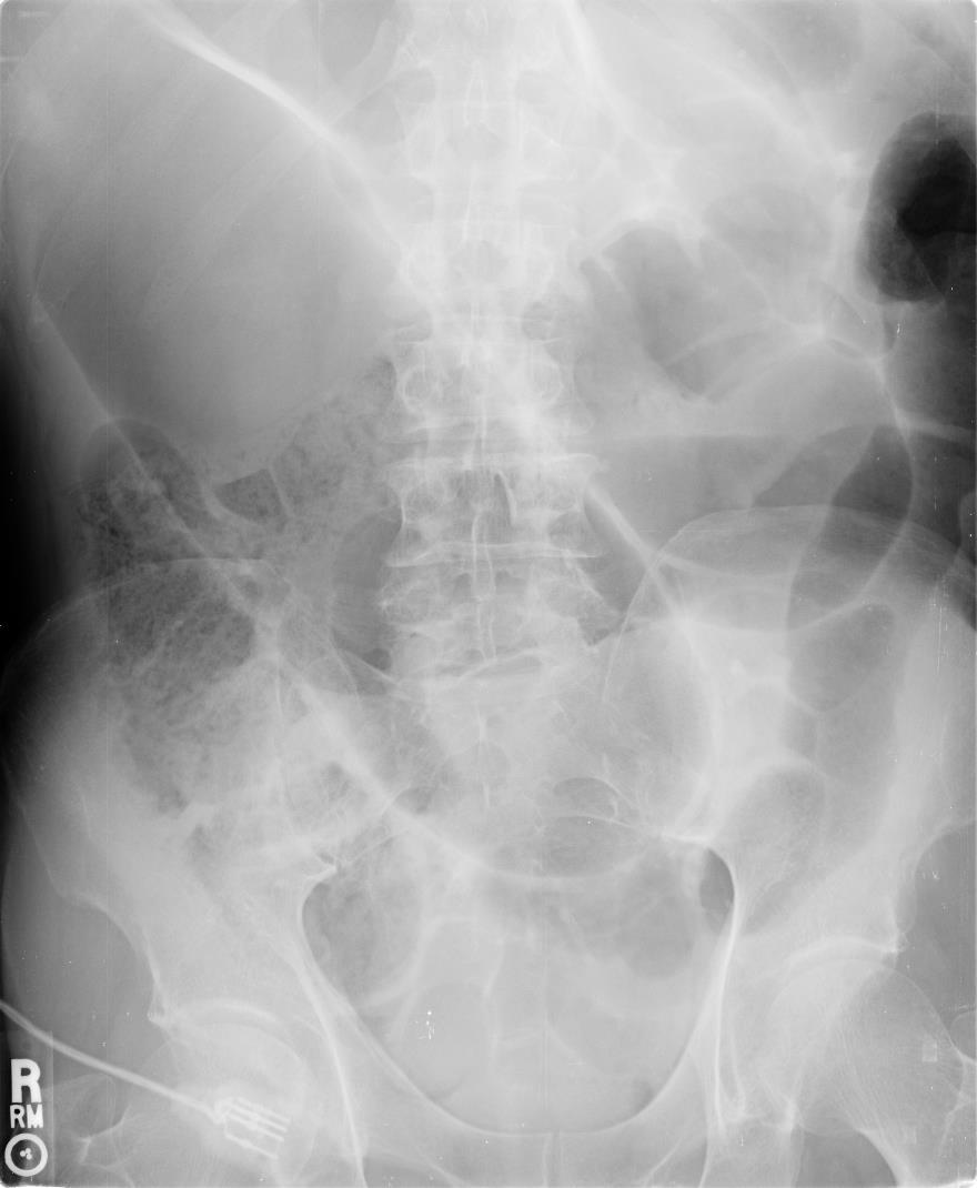 Volvulus Occurs mostly in distal 30 cm of colon R/O necrosis or perforation Goal to untwist sigmoid: insufflation and insertion