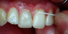 The efficacy of dental floss in addition to a toothbrush on plaque and parameters of gingival inflammation: a systematic review. Int J Dent Hyg.