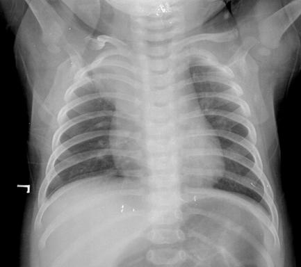 Iran J Pediatr, Vol 21 ( 3); Sep 2011 405 report an additional case of aberrant thymus in the posterior mediastinum, which was diagnosed through thoracotomy.