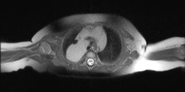 406 Posterior Mediastinal Thymus: A Case Report; L Jiang, et al Fig. 3a: Axial T2 MRI demonstrates the mass in continuity with the normal thymus. Thymus and the mass have similar signal intensity.
