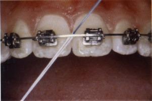 With braces exactly the same be Careful not to pull down the floss As the brace is on the way. How did I do?
