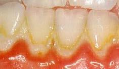Poor Oral Health can lead to among of things 1Tooth decay 2 Gum diseases 3 Halitosis (Bad breath)