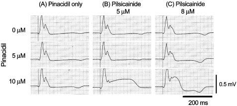 Kimura et al Mechanism of VT in Brugada Syndrome 127 Figure 2. Two types of ST elevation induced by pinacidil and pilsicainide in 1 preparation.