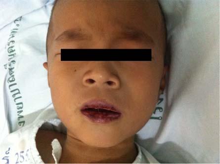 Case Report A six-year-old boy was referred to our department with erythematous cracked lips (Fig. 1), injected conjunctiva, and some erosions on his penis for two days.