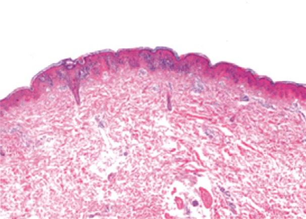 L.C. Lin, P.C. Lai, S.F. Yang, and R.C. Yang A B C D Figure 2. Microscopic findings of skin biopsy.