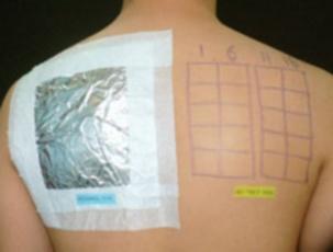 the test area Photopatch test might be negative, if the photoallergen is a drug