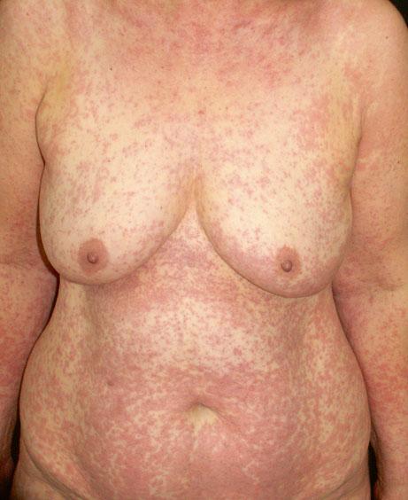 4 1 General Aspects of Adverse Cutaneous Drug Reactions Characteristic Features of Adverse Cutaneous Drug Reactions Maculopapular Drug Eruption Maculopapular eruption, also known as morbilliform