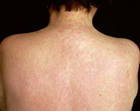 6 1 General Aspects of Adverse Cutaneous Drug
