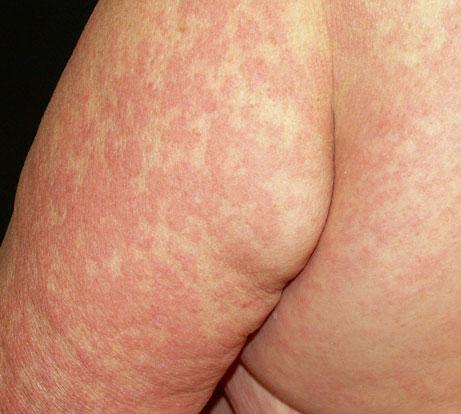 4 Maculopapular drug eruption on the back skin
