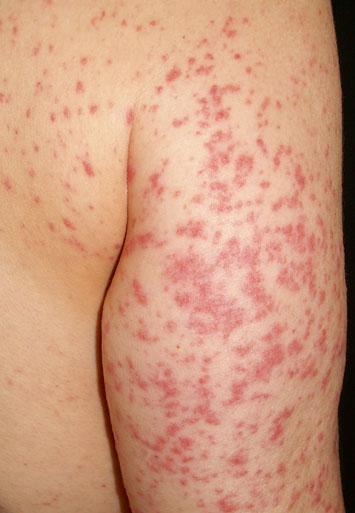 Characteristic Features of Adverse Cutaneous Drug