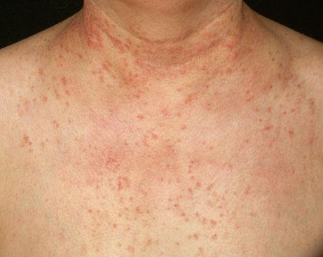 Characteristic Features of Adverse Cutaneous Drug Reactions 15