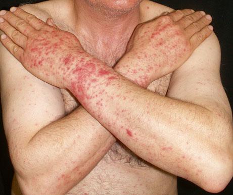 16 1 General Aspects of Adverse Cutaneous Drug Reactions Fig. 1.23 Lichenoid photosensitivity reaction on sun-exposed areas of the hands and arms showing small, shiny, reddish papules (note the
