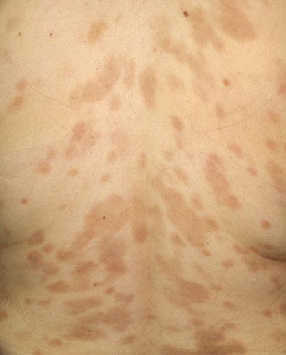 28 Fixed drug eruption: dusky red-colored, large, confluent plaques on the