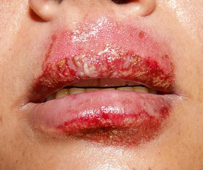 20 1 General Aspects of Adverse Cutaneous Drug Reactions Fig. 1.30 Fixed drug eruption (FDE): involvement of lips. Well-defined plaques with vesicles and erosions.
