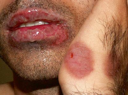 31 Fixed drug eruption: involvement of the lips showing bullae and erosions.